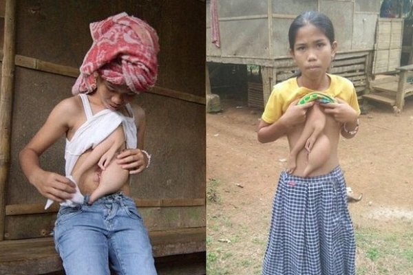 Филлипинскую девочку-мутанта прооперируют в Таиланде